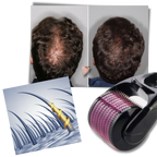 Rouleau dermique pour la croissance des cheveux et de la barbe