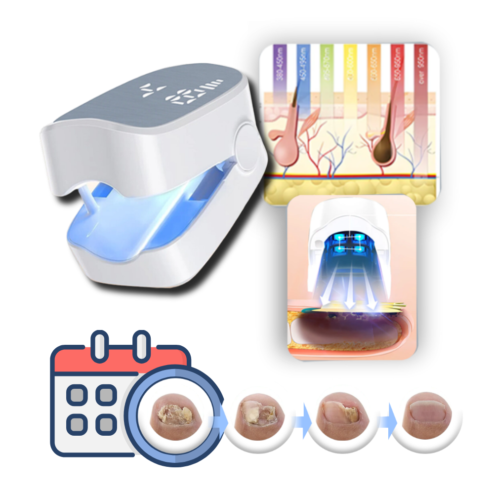 Laser indolore pour les mycoses des ongles