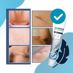 Crème hydratante au silicone pour cicatrices de grossesse